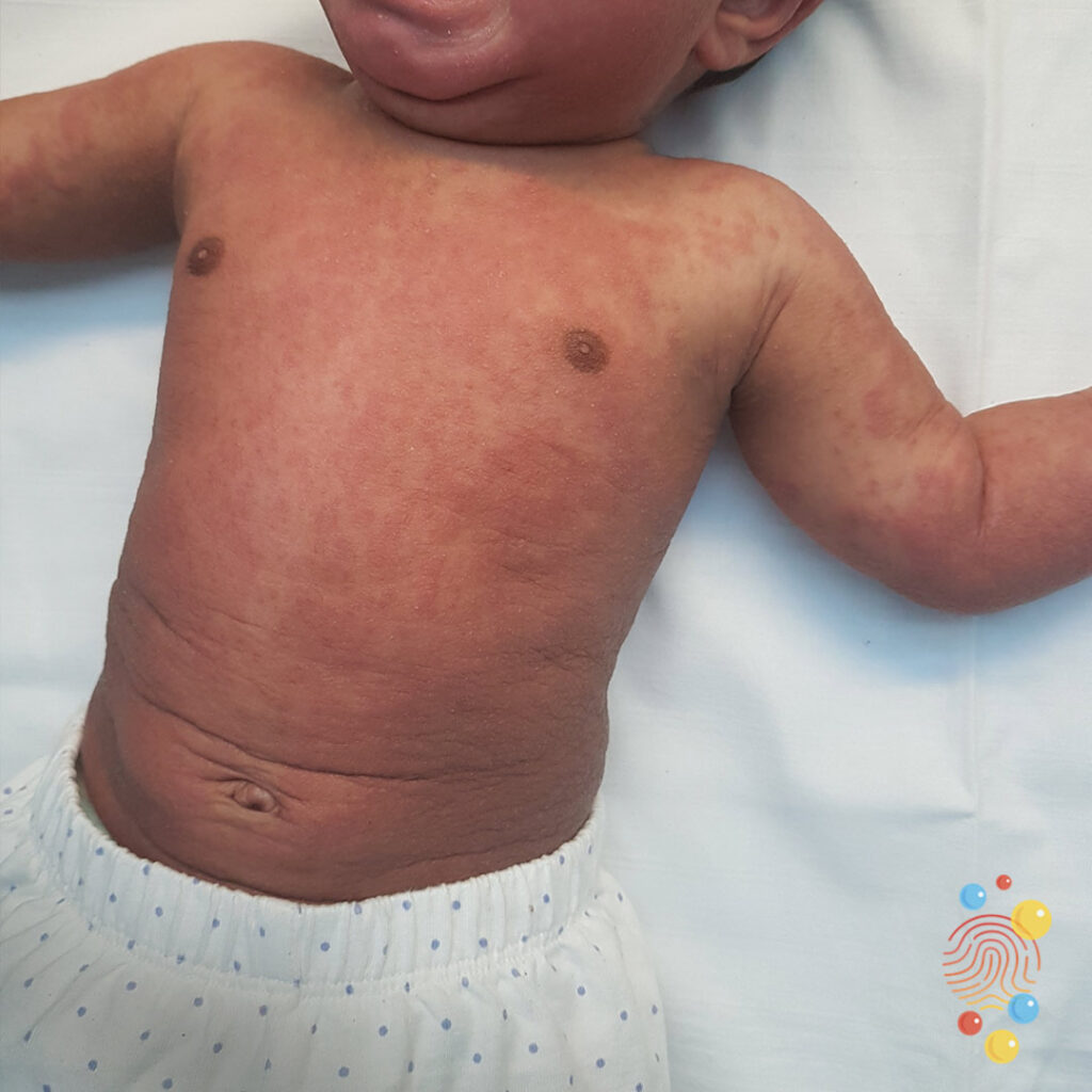 Eczema