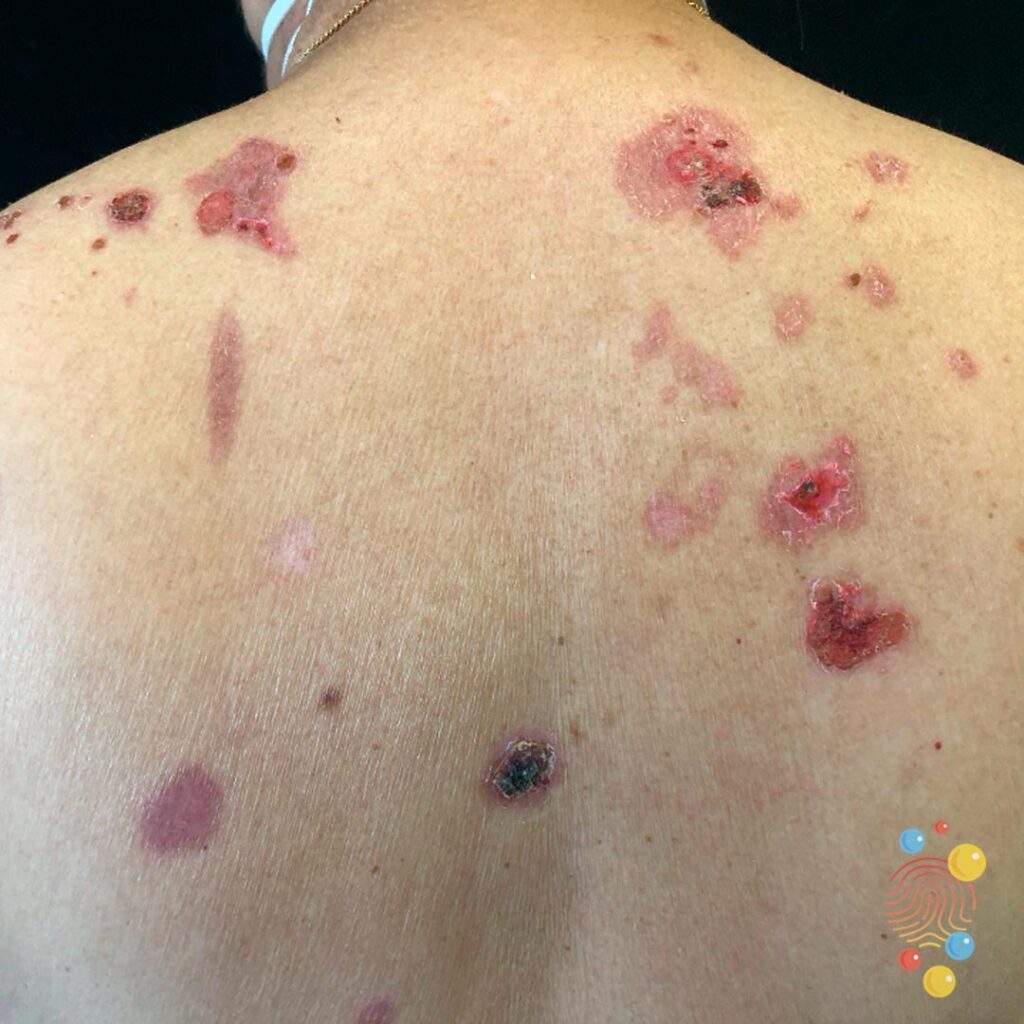 Pemphigus