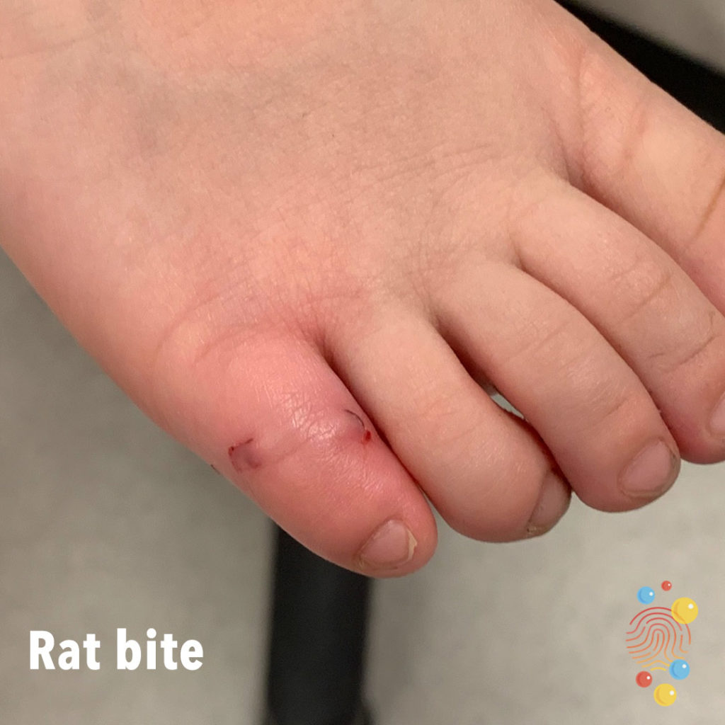 Rat Bite