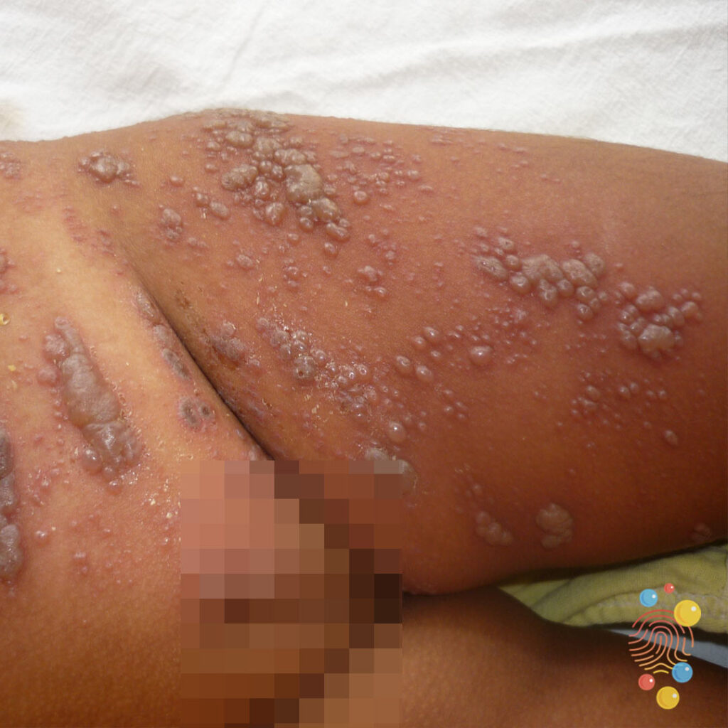 Chicken Pox