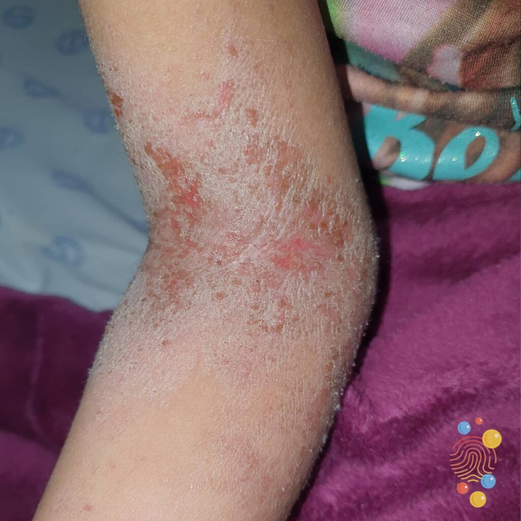 Eczema