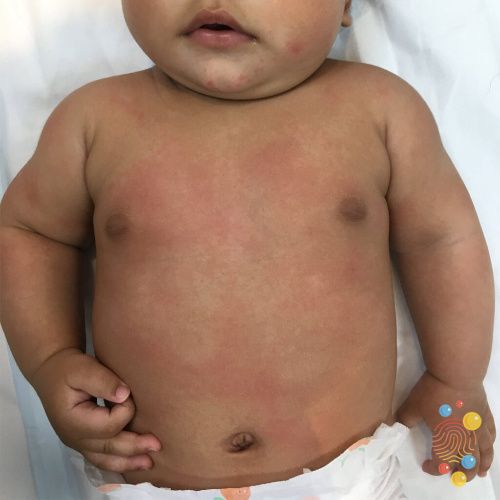 Urticaria