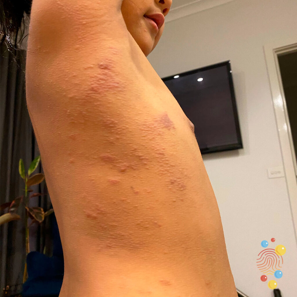 Papular eczema