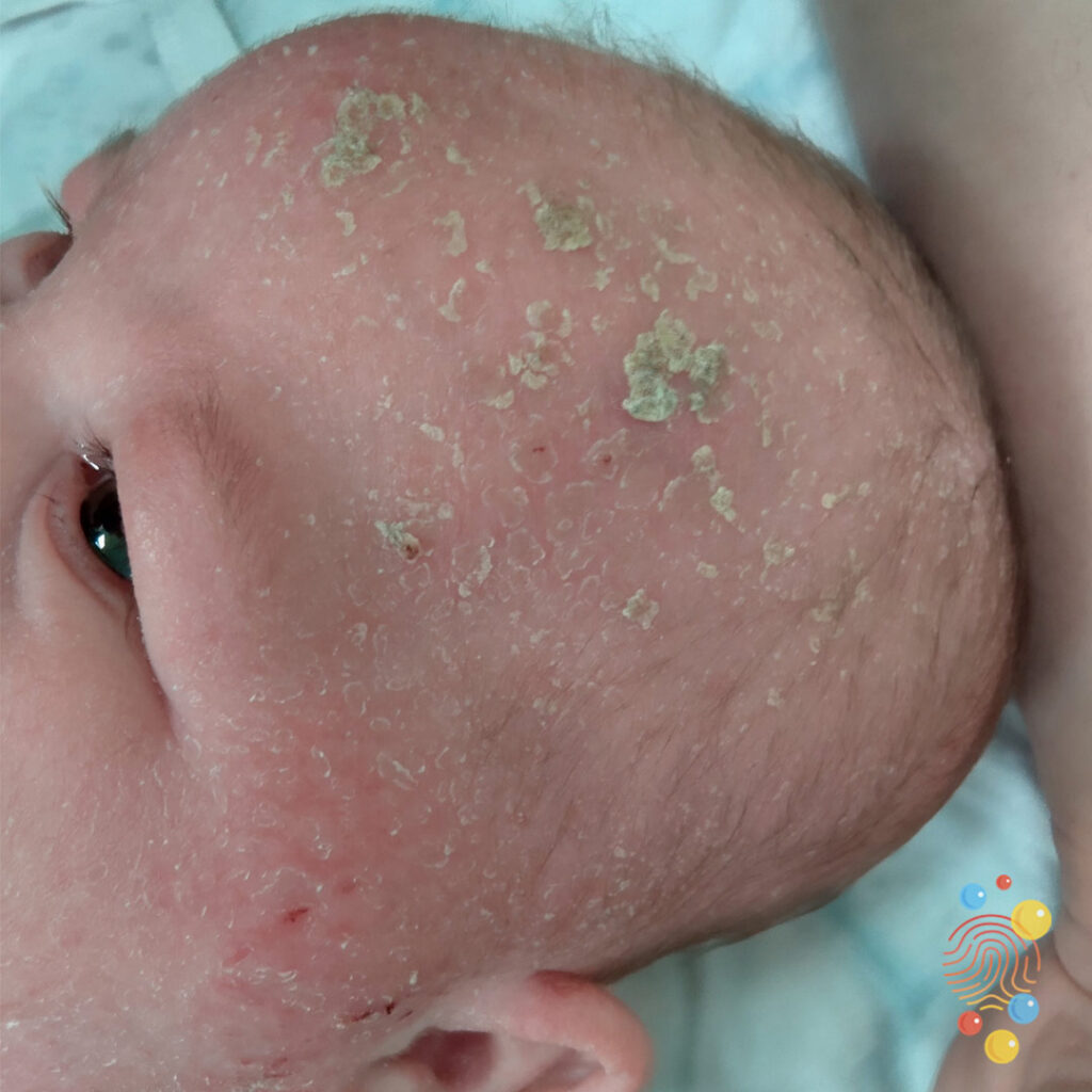 Cradle Cap