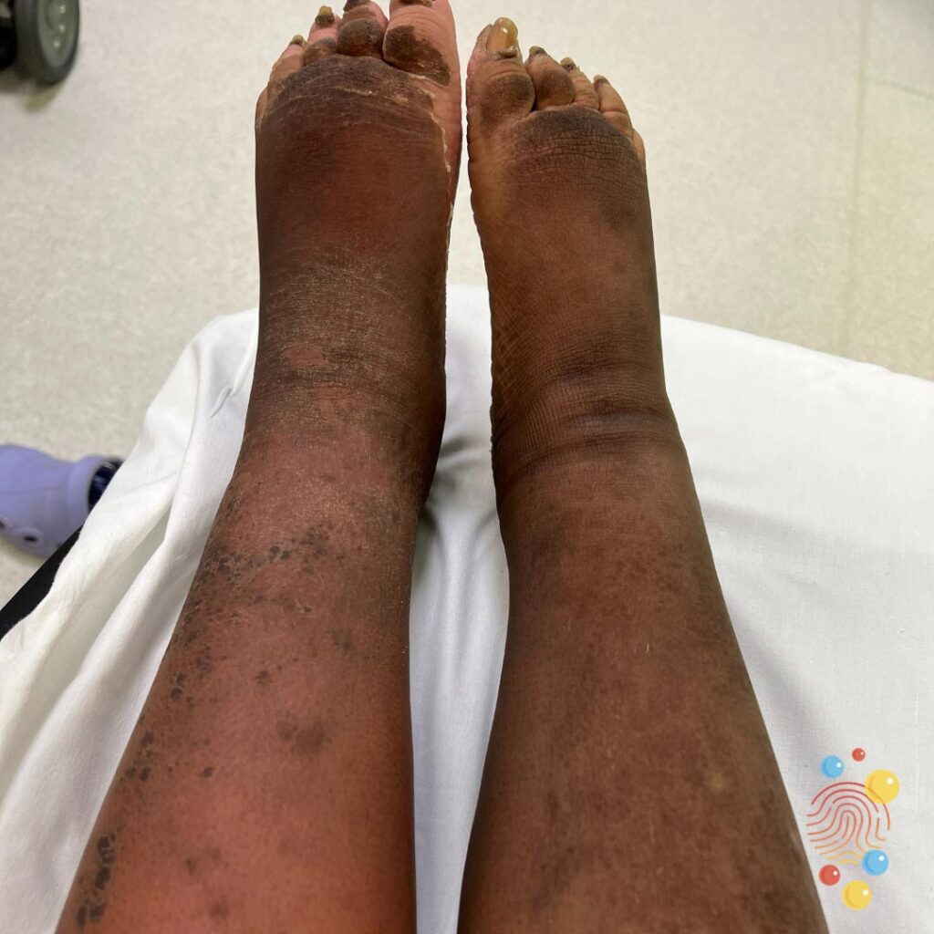 Lymphoedema and hyperkeratosis
